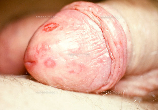 チンポに出現した梅毒環状紅斑